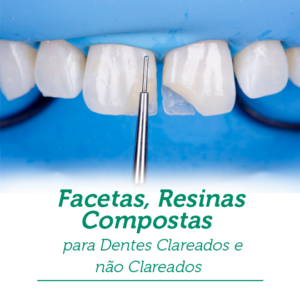 Facetas, Resinas Compostas para Dentes Clareados e não Clareados