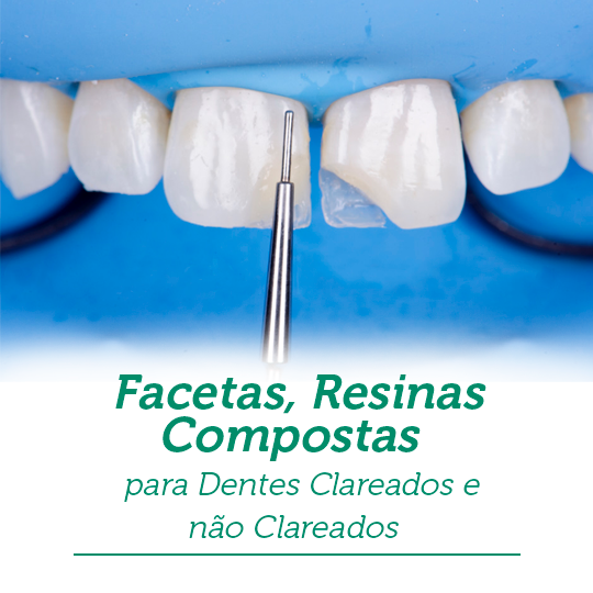 Leia mais sobre o artigo Facetas, Resinas Compostas para Dentes Clareados e não Clareados