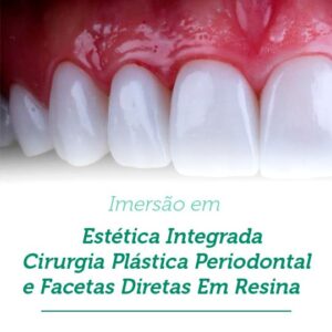 Estética Integrada Cirur. Plástica Perio. e Facetas Diretas em Resina